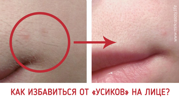 Как избавиться от усов навсегда и быстро в домашних условиях