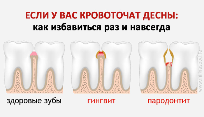 Чем лечить кровотечение зубов Чем лечить кровотечение зубов