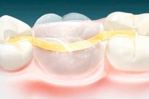 адгезивное протезирование зубов