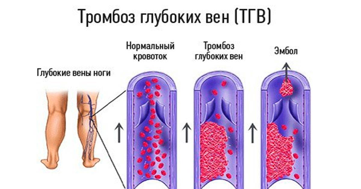 Тромбы в венах ног